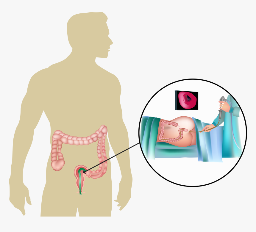 Sigmoidoscopy, HD Png Download, Free Download