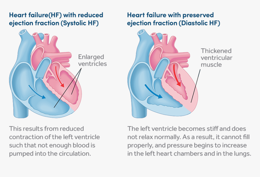 Transparent Heart Organ Png - Heart Failure Diagram, Png Download, Free Download