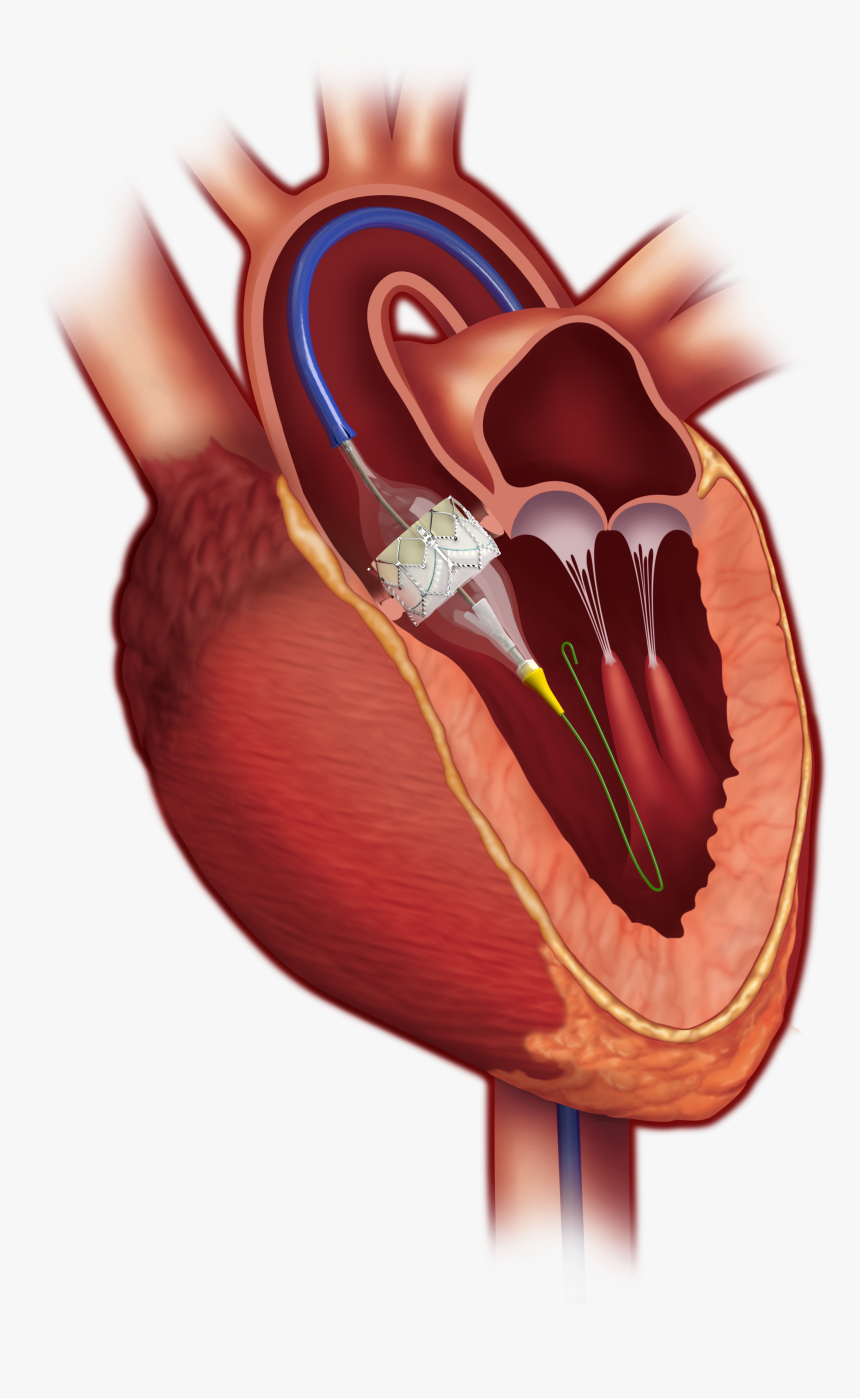 Heart Valve Replacement - Transcatheter Aortic Valve Replacement, HD Png Download, Free Download