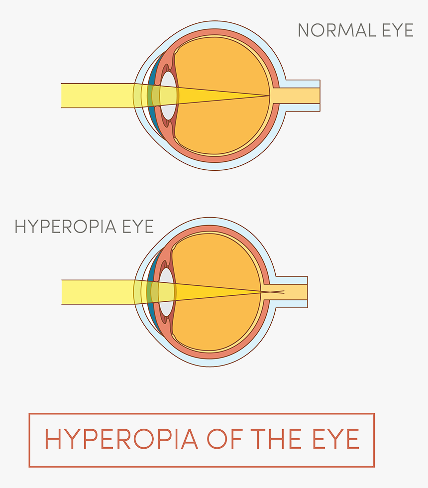 Illustration Of Human Eye - Hyperopia, HD Png Download, Free Download