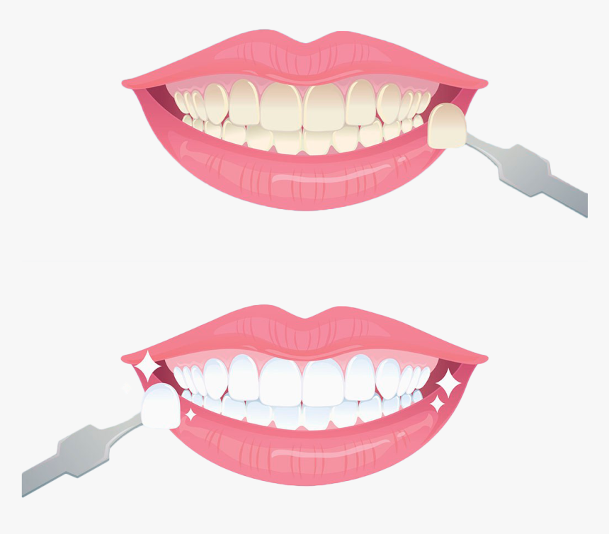 Tooth Whitening Euclidean Vector - Teeth Whitening Clipart, HD Png Download, Free Download