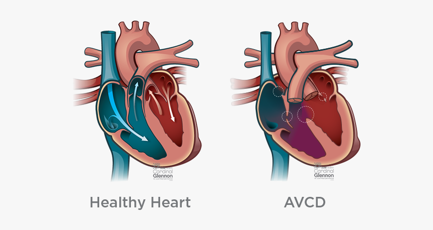 Side By Side Avcd - Septal Defects, HD Png Download, Free Download