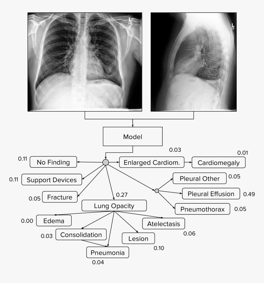Chest Radiograph, HD Png Download, Free Download