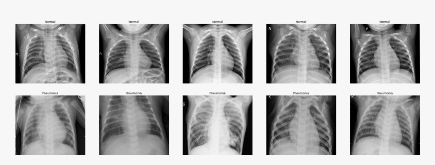 X Ray Of Pneumonia, HD Png Download, Free Download