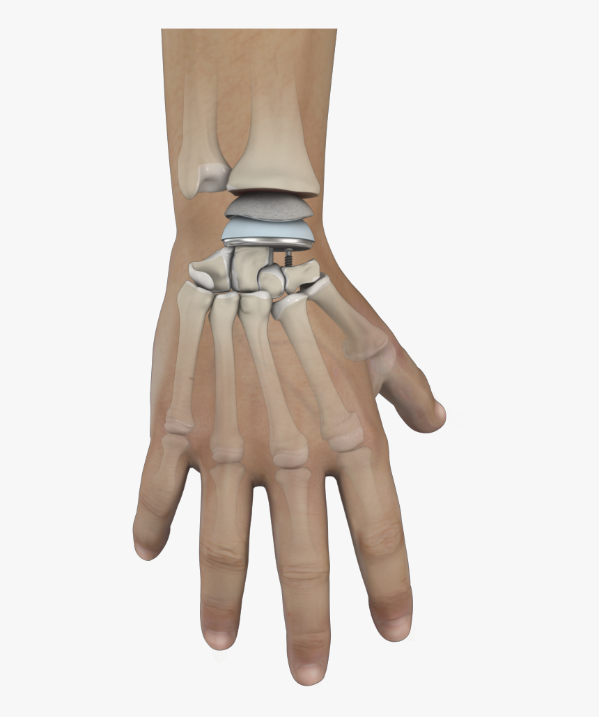Wrist Joint Replacement, HD Png Download, Free Download