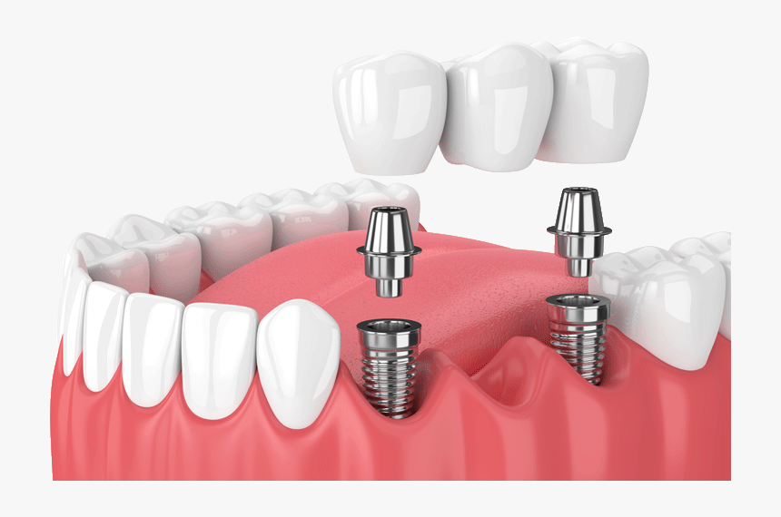 Implant Bridge, HD Png Download, Free Download