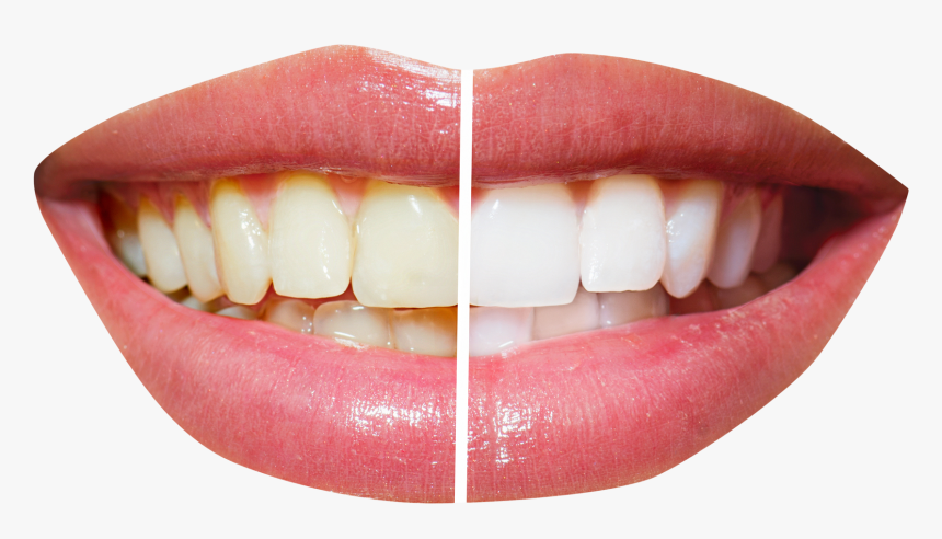 Free Icons Png - Teeth Whitening, Transparent Png, Free Download