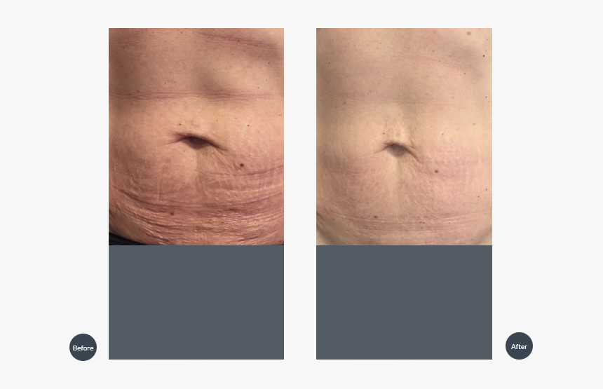 Tixel For Stretch Marks Before After, HD Png Download, Free Download
