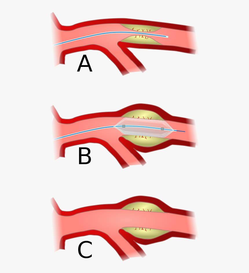 Percutaneous Coronary Intervention Hd Clipart , Png - Statistics On Cardiovascular Disease In Australia, Transparent Png, Free Download