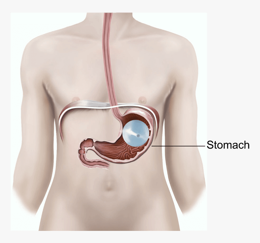 Illustration Showing A Gastric Balloon In The Stomach - Gastric Balloon, HD Png Download, Free Download