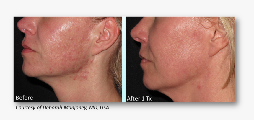 Manjoney - Lutronic Genius Acne Scarring, HD Png Download, Free Download