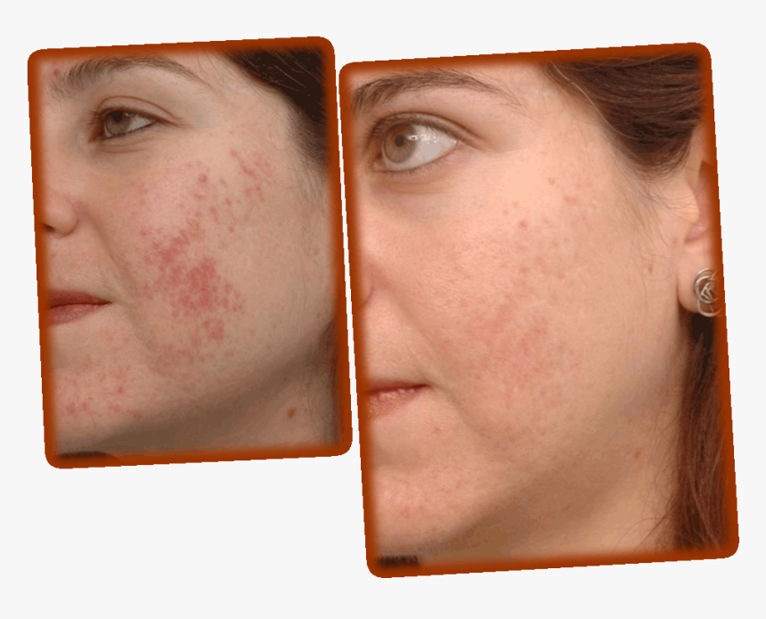 Effective Acne Scar Removal - Microdermabrasion Before And After, HD Png Download, Free Download