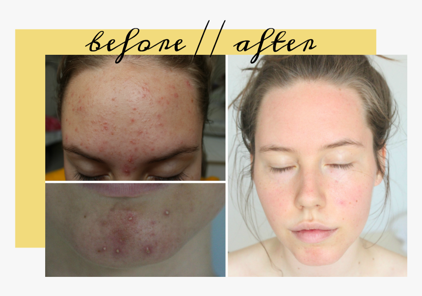 Medical Medium Acne Protocol, HD Png Download, Free Download