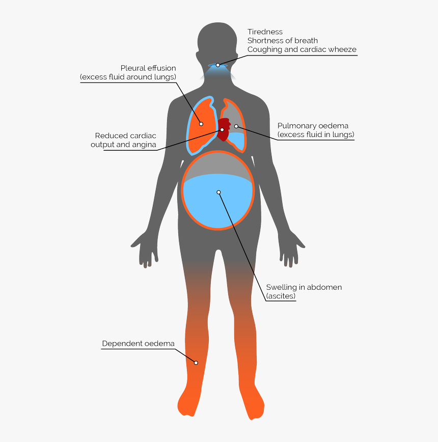 Heart Failure Signs And Symptoms, HD Png Download, Free Download