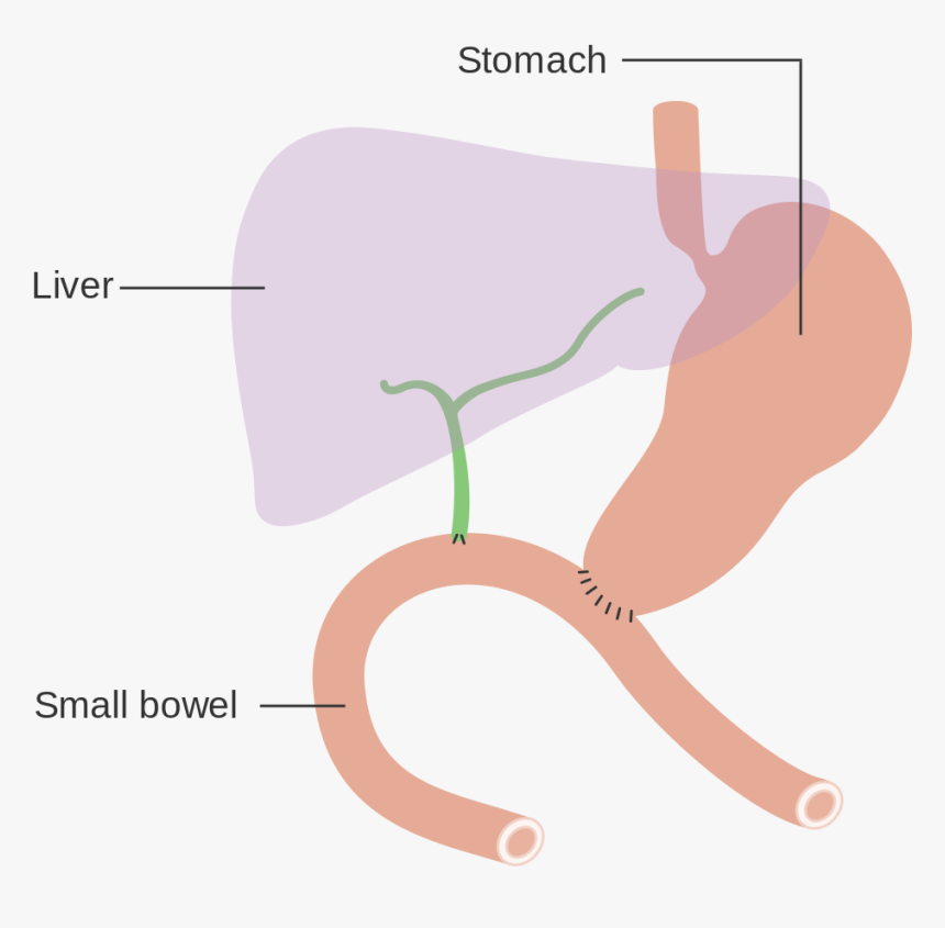 Total Pancreatectomy And Splenectomy, HD Png Download, Free Download