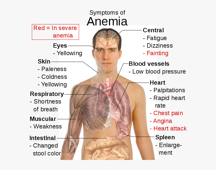 Symptoms Of Anaemia - Symptoms Of Anemia, HD Png Download, Free Download