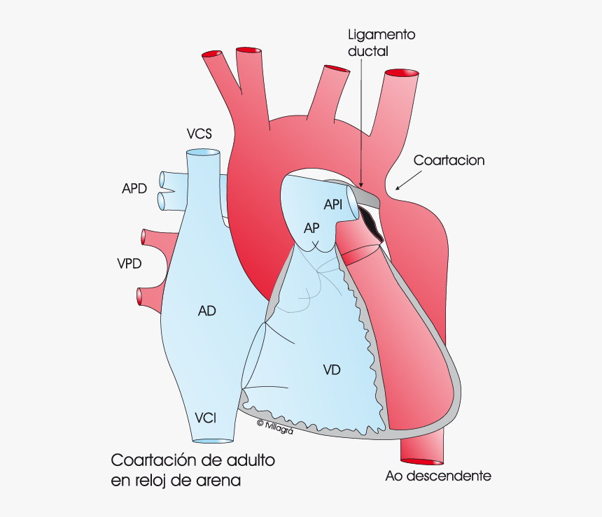 Coartacion De La Aorta Adultos, HD Png Download, Free Download