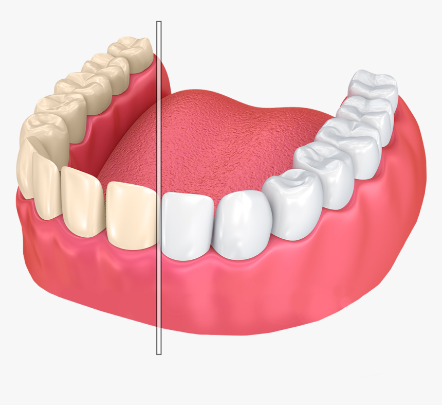 Tooth Discoloration - Porcelain Veneers Composite Bonding Tooth Chipped Tooth, HD Png Download, Free Download