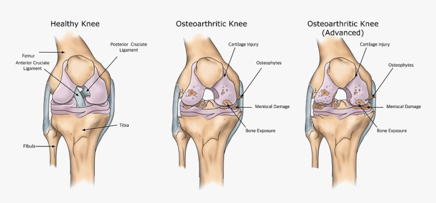 Osteoarthritis Knee Joint - Total Knee Replacement Causing Osteoarthritis, HD Png Download, Free Download