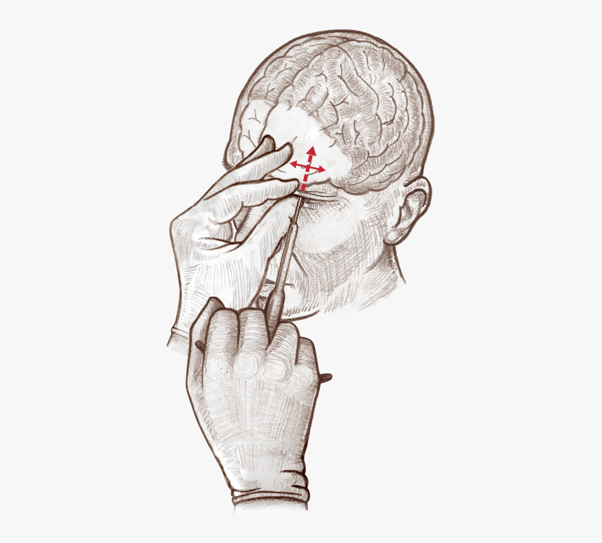 Frontal Lobotomy Lobotomy Scar, HD Png Download, Free Download