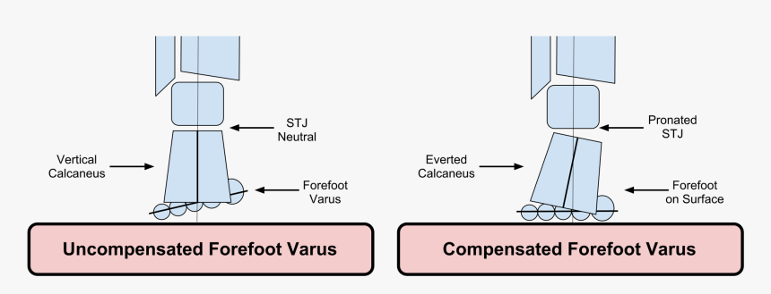 Compensated Vs Uncompensated Forefoot Varus, HD Png Download, Free Download