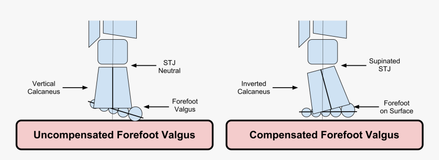 Compensated Vs Uncompensated Forefoot Varus, HD Png Download, Free Download