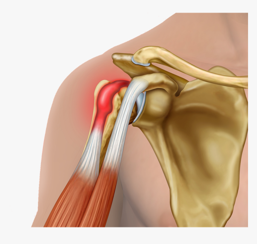 Biceps Tendinitis, HD Png Download, Free Download