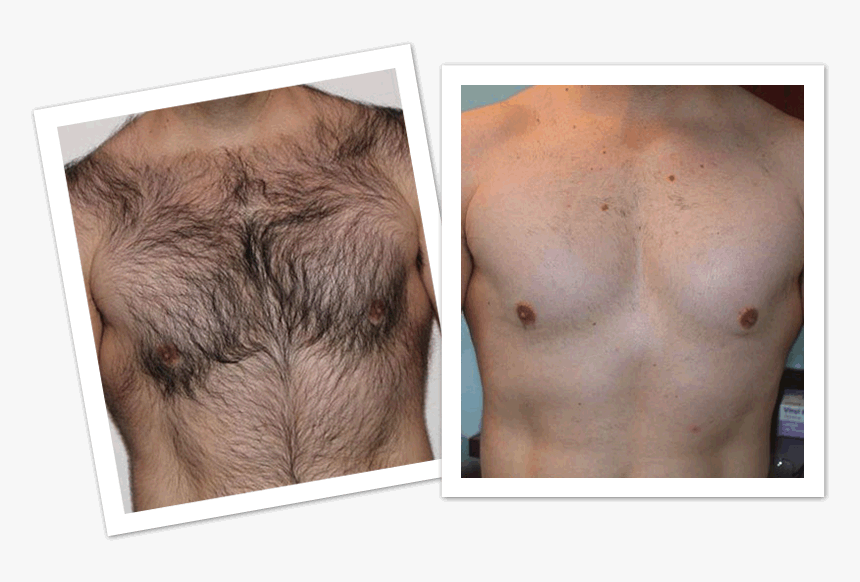 Mens Laser Hair Removal Before And After, HD Png Download, Free Download