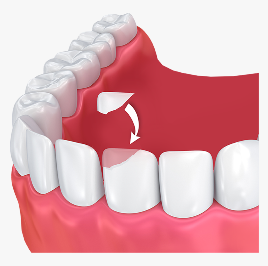 Google Tooth Bonding Illustration, HD Png Download, Free Download