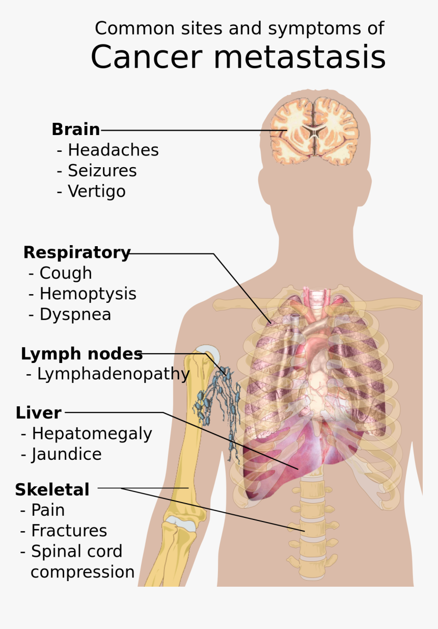 Common Sites And Symptoms Of Cancer Metastasis, HD Png Download, Free Download