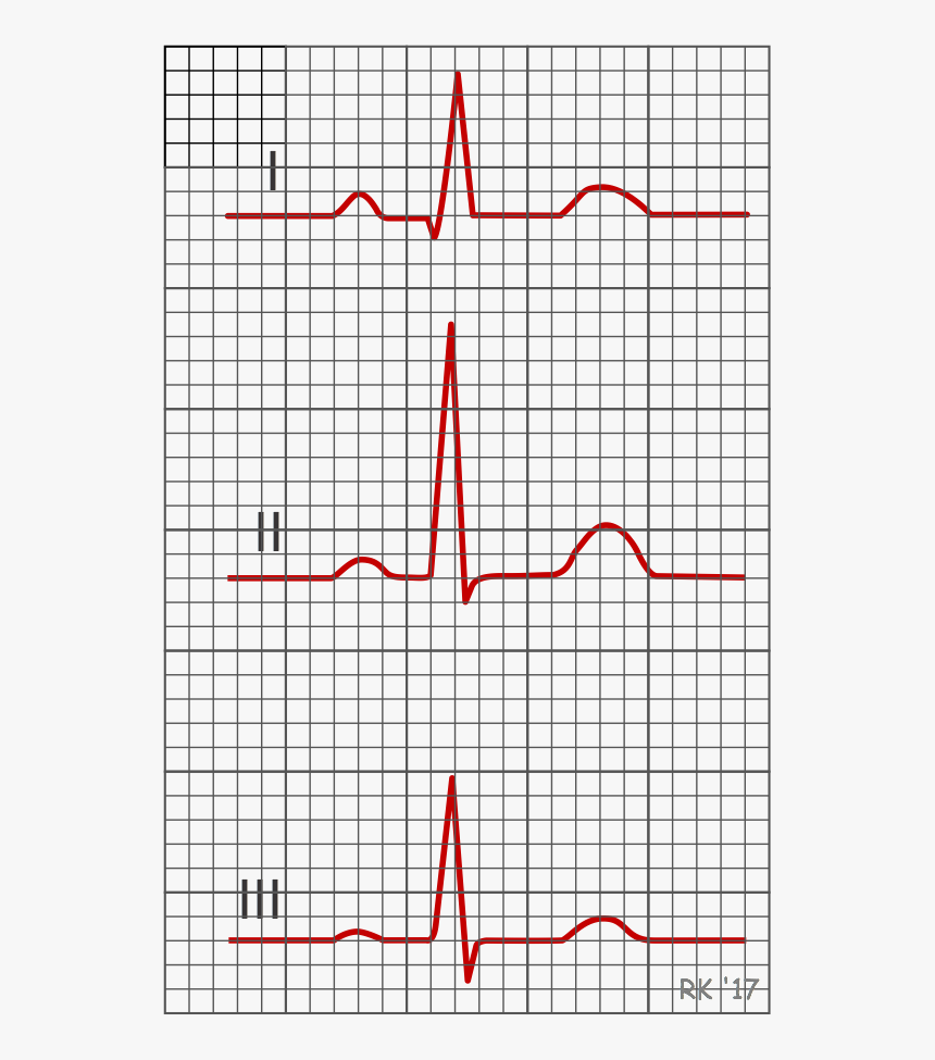 Transparent Ecg Png - Ecg In Lead 2, Png Download, Free Download