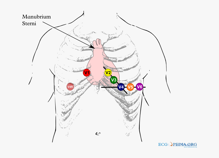 Brugada Syndrome Ecg Placement, HD Png Download, Free Download