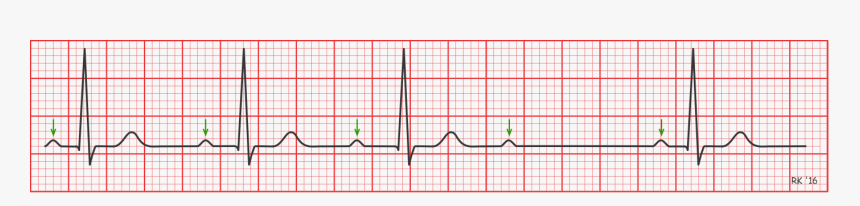 Sinus Bradycardia With 1st Degree Av Block, HD Png Download, Free Download