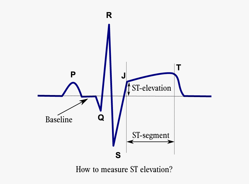 Ecg Of Mi Patient, HD Png Download, Free Download