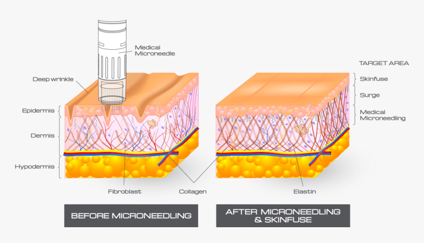 Cross Section@2x-1024x540 - Microneedling Works, HD Png Download, Free Download