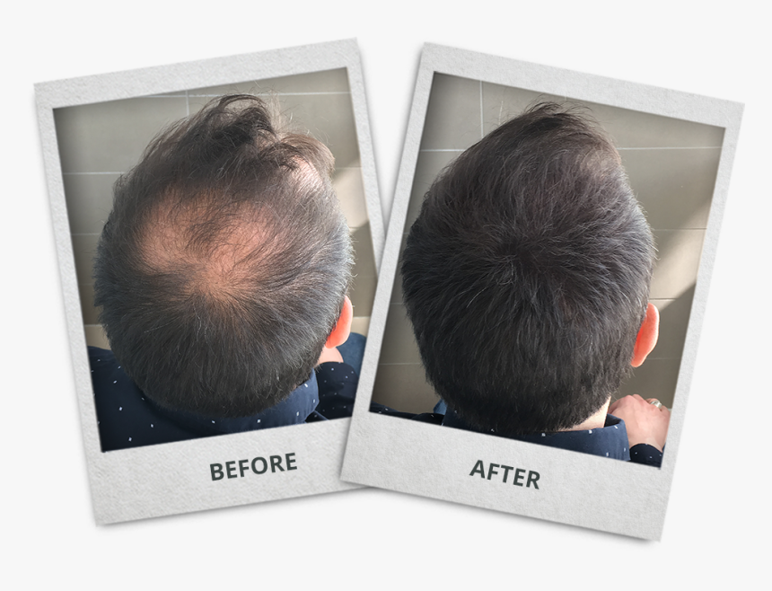 Alfy Hair Before After, HD Png Download, Free Download