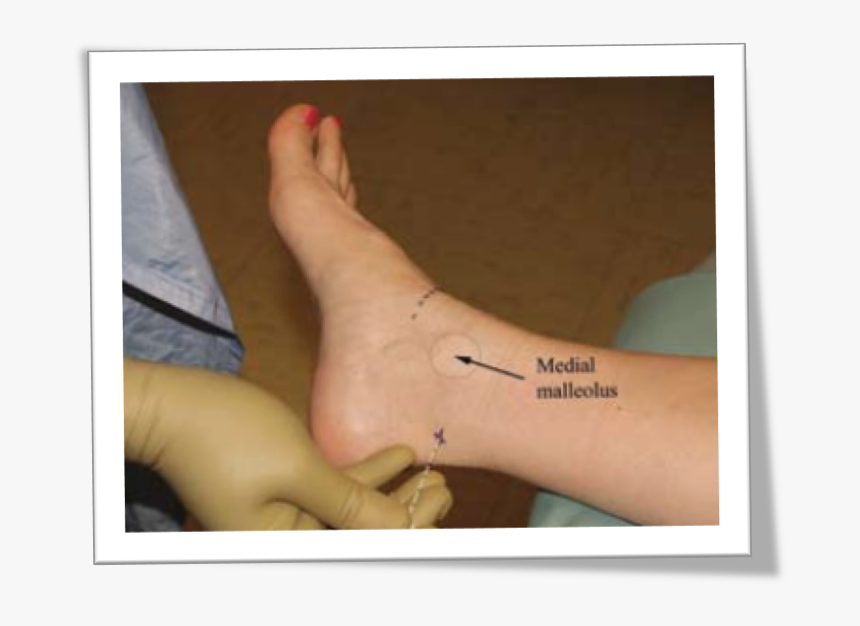 A Patient"s Bare Foot And Ankle Can Be Seen Resting - Toe, HD Png Download, Free Download