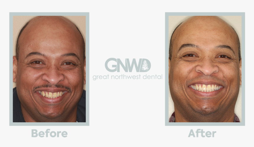 James1 - Invisalign Before And After Wdult, HD Png Download, Free Download