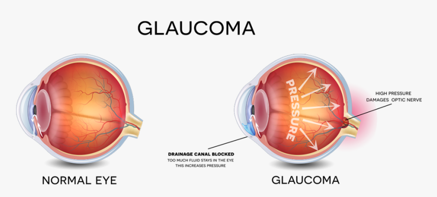 Glaucoma - Eye Glaucoma, HD Png Download, Free Download