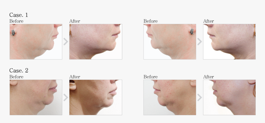 Dermaheal Ll Before And After, HD Png Download, Free Download