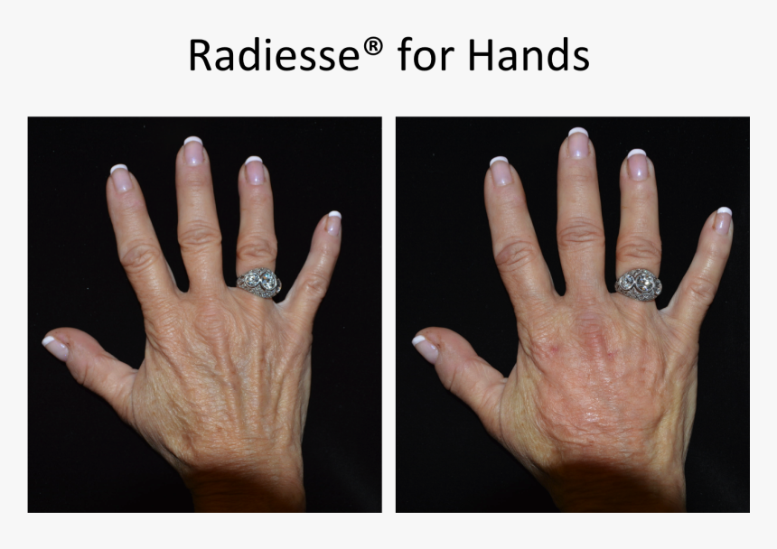 Before And After Radiesse For Hands - Engagement Ring, HD Png Download, Free Download