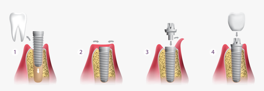 Dental Implants Diagram - Screwdriver, HD Png Download, Free Download