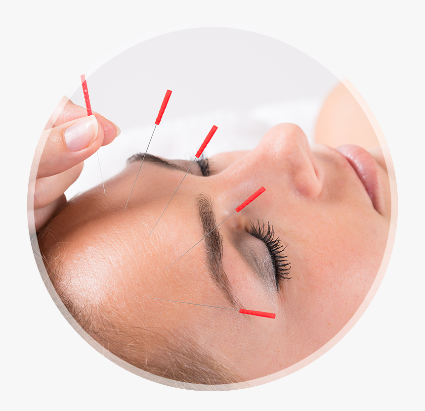 Louisville Acupuncture Treatment - Do They Do Acupuncture For Headaches, HD Png Download, Free Download