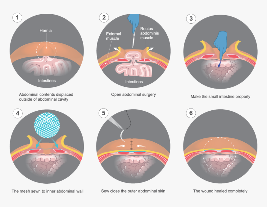 Herniamesh-illustration - Ventrale Hernia, HD Png Download, Free Download
