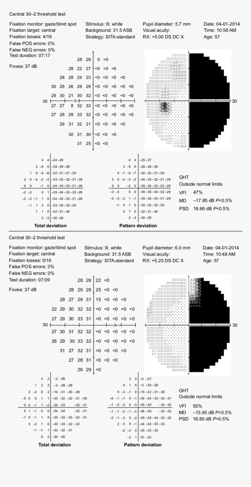 Bitemporal Hemianopia Humphrey 30 2, HD Png Download, Free Download