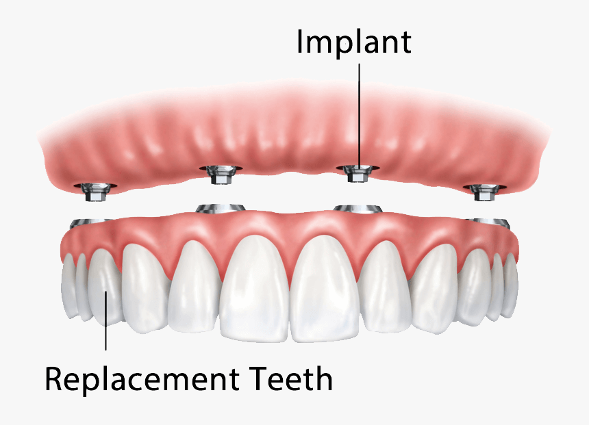Replace All Teeth Permanently - Implant Dentures, HD Png Download, Free Download