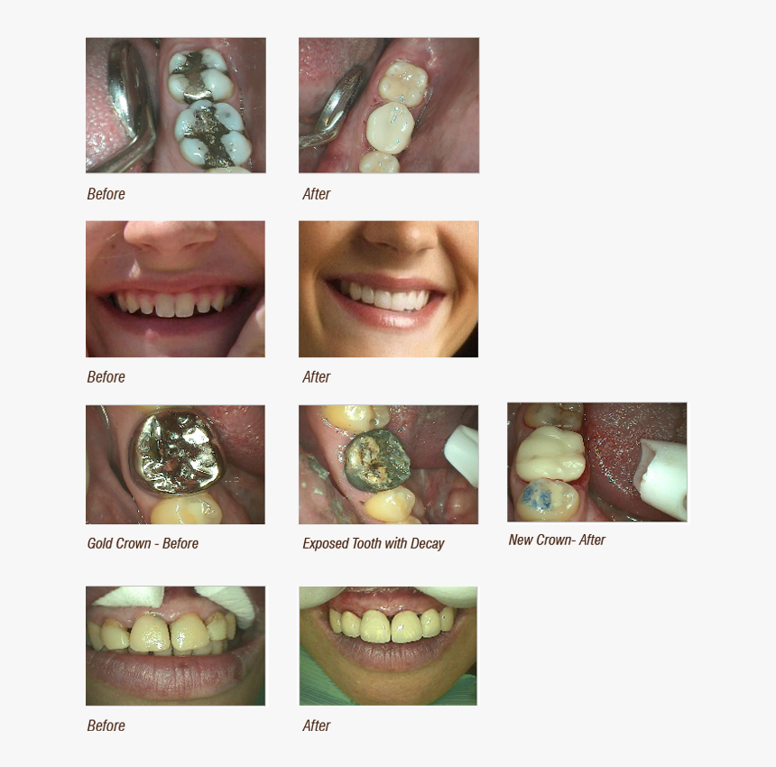 Before And After Cosmetic Dentistry Image - Tongue, HD Png Download, Free Download