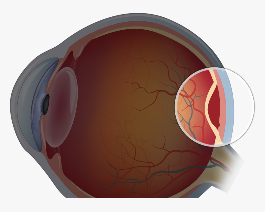 Retinal Detachment - Circle, HD Png Download, Free Download