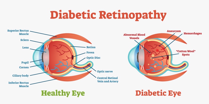 Retinal Detachment Scleral Buckle, HD Png Download, Free Download