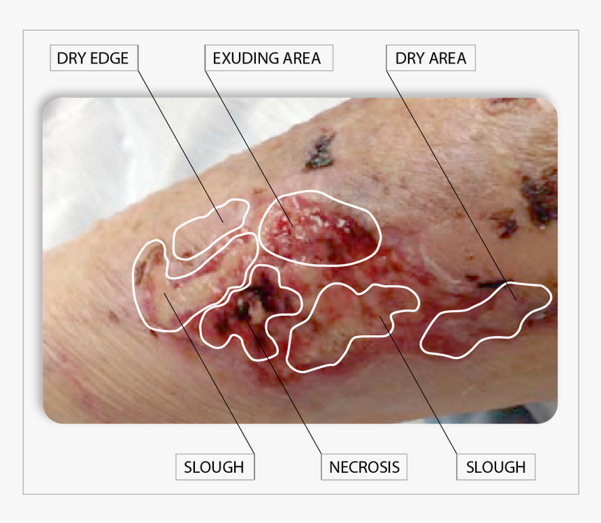 Desiccation Wound, HD Png Download, Free Download